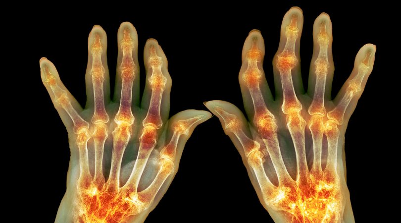 Raio-x de mãos com inflamação nas articulações - artrite reumatoide