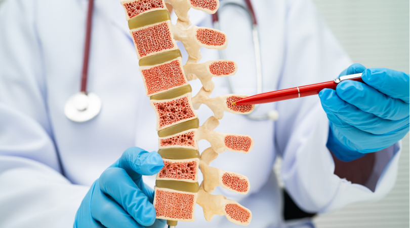 Médico explicando modelo de coluna vertebral com osteoporose - reumatologia
